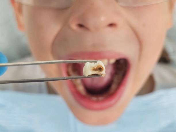 Best Chipped Tooth Repair Near Me  in Springfield, MO